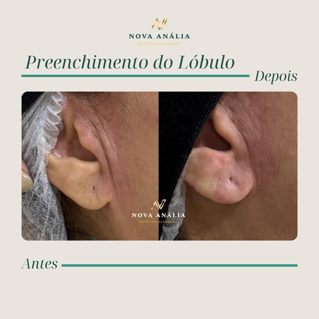 Antes e depois — Preenchimento do Lóbulo