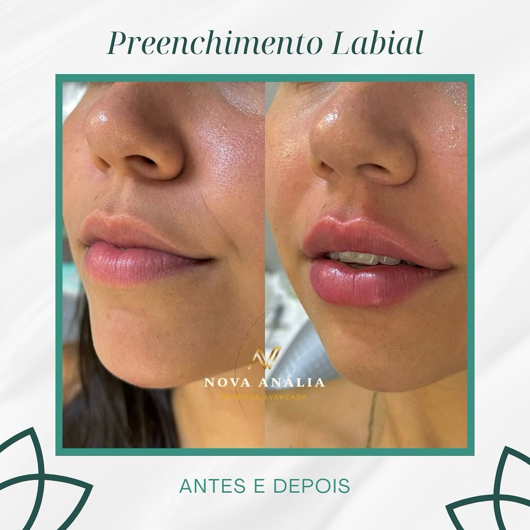 Antes e depois — Preenchimento Labial