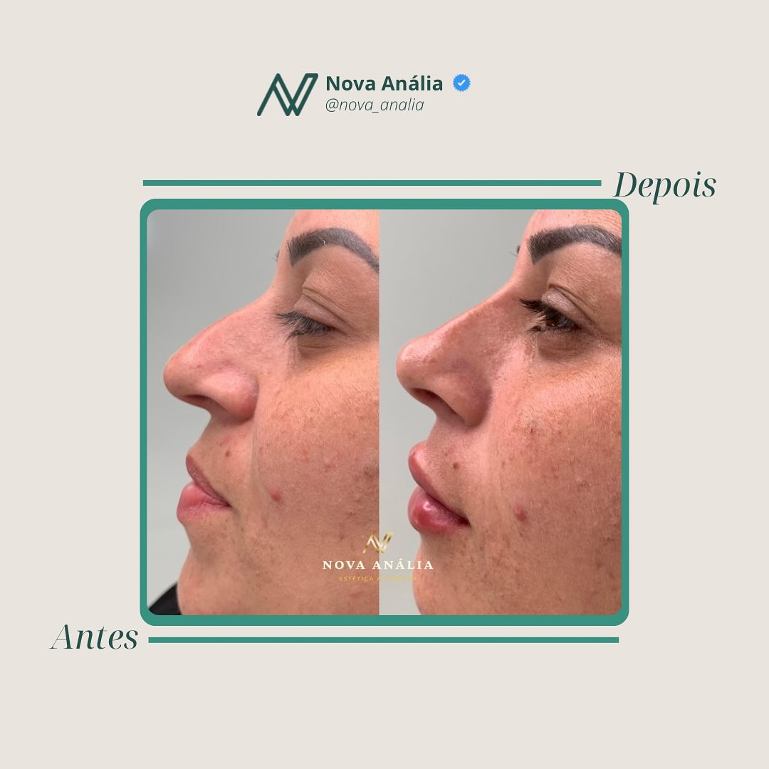 Antes e depois — Perfil Refinado
