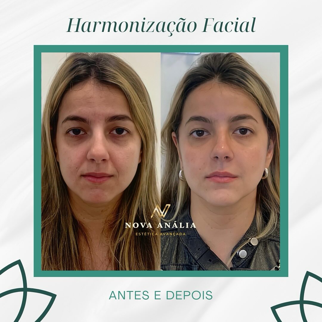 Antes e depois — Harmonização Facial