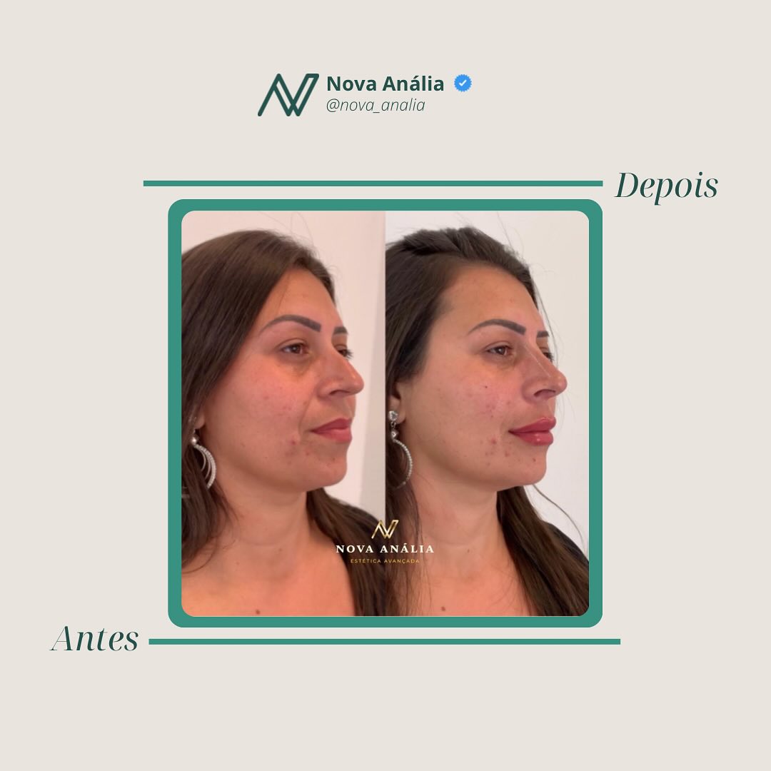 Antes e depois — Projeção e Contorno